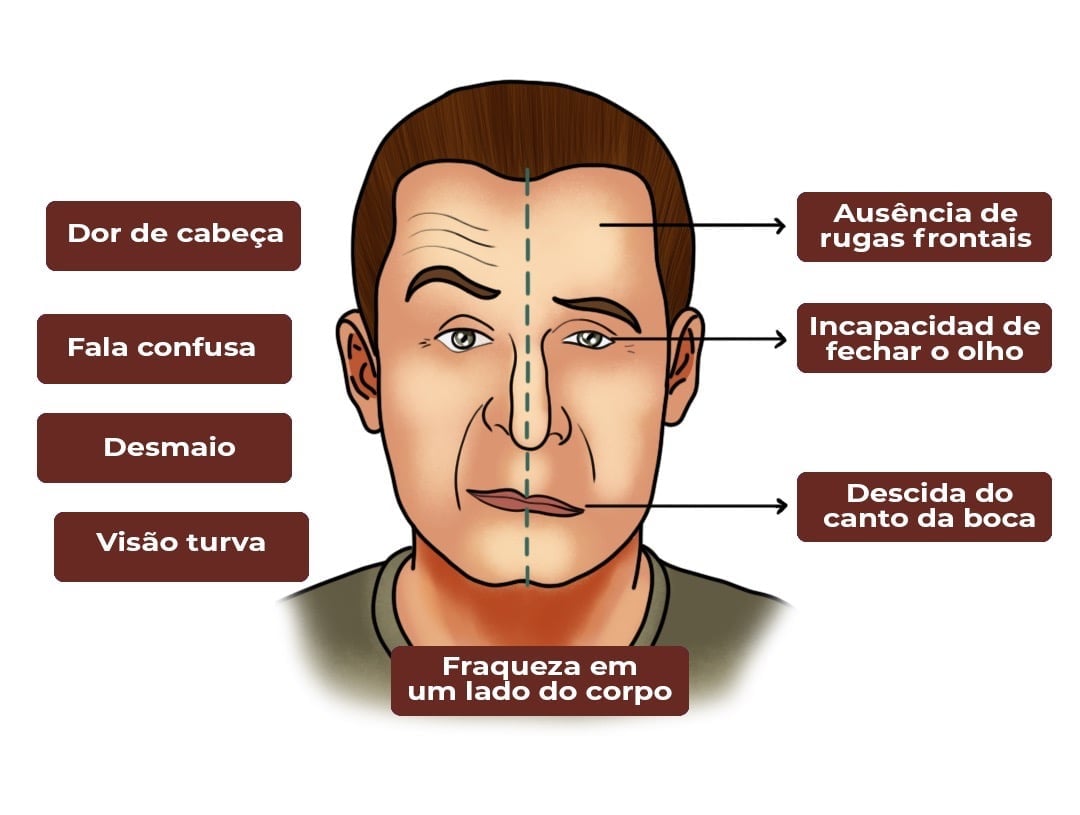 Acidente Vascular Cerebral Avc Causas Tratamentos E Preven O Para