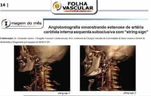 Estenose