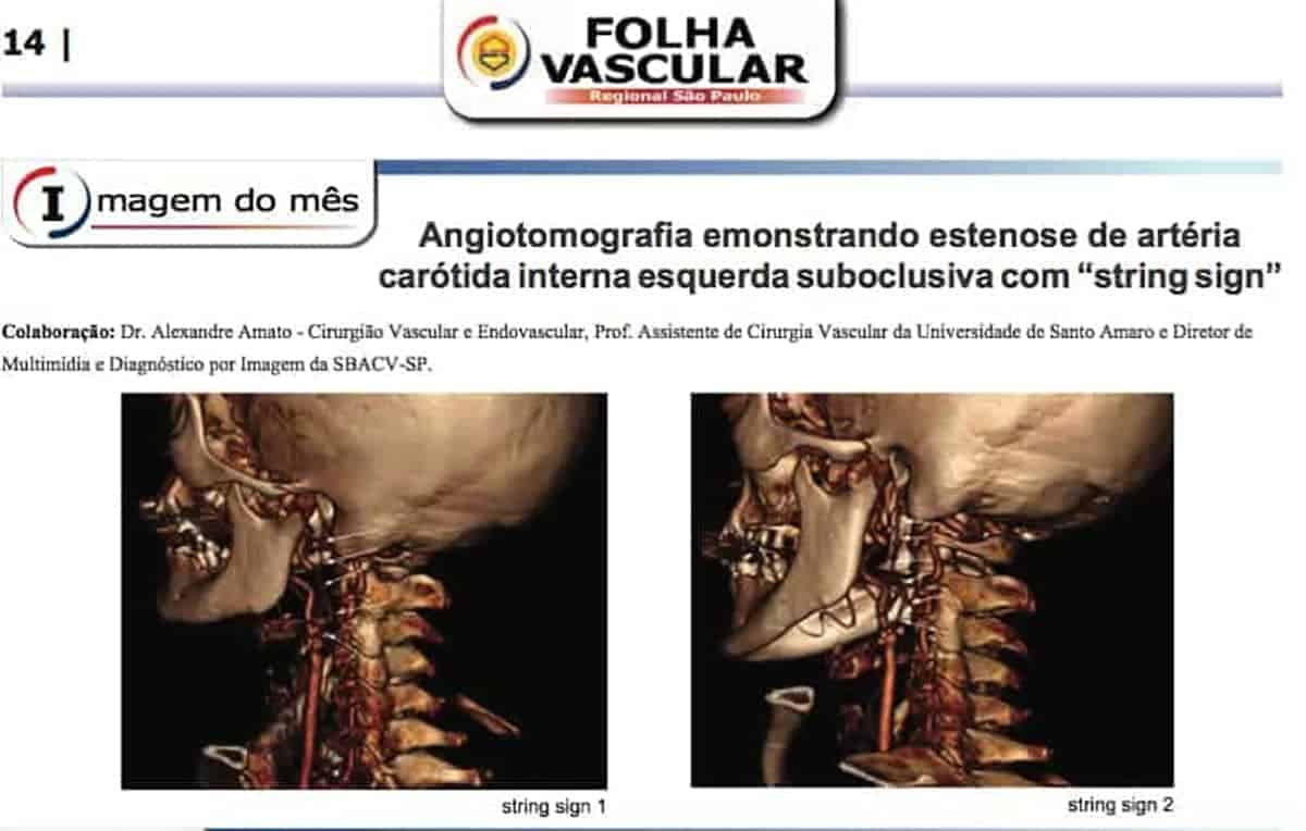 Estenose carotídea com string sign: um caso publicado na SBACV