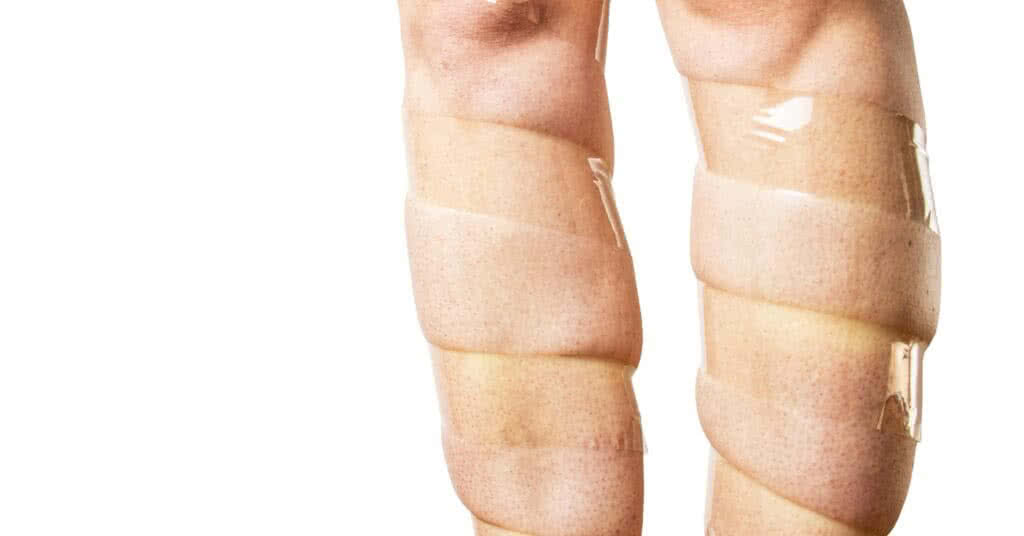 Imagem ilustrativa para o artigo sobre tratamento para varizes: pernas femininas enfaixadas representam o conceito de veias varicosas. Descubra se há tratamento para varizes e como prevenir essa condição.
