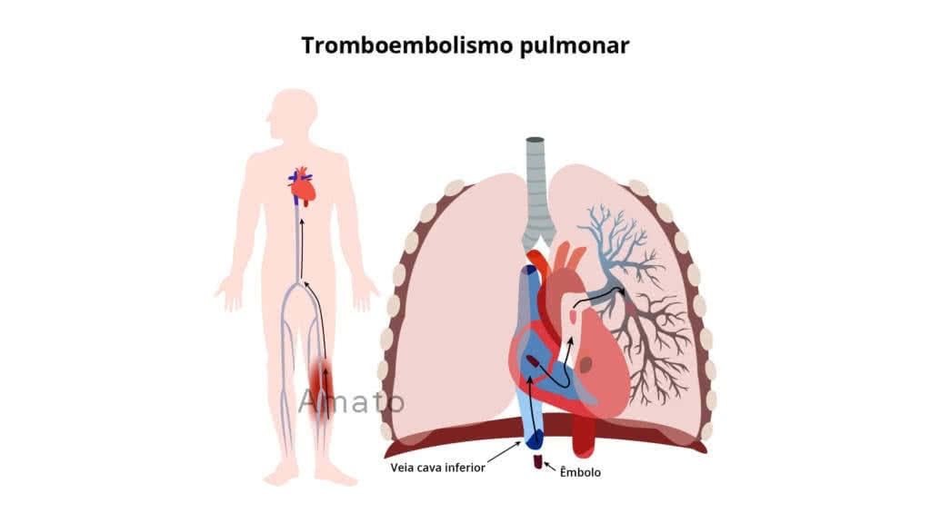 tromboembolismo pulmonar