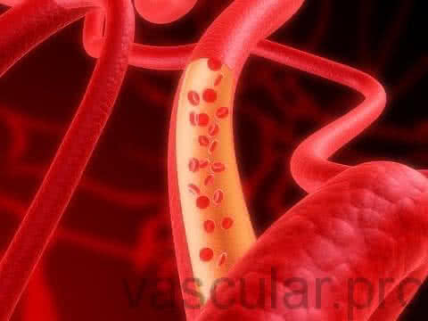 Doenças vasculares - Vaso sanguíneo