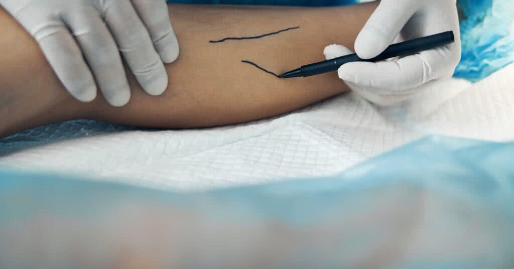 Imagem ilustrativa para o artigo "A cirurgia de varizes é um procedimento seguro?" no site Vascular.pro. Médico preparando o paciente para a operação cirúrgica de varizes.