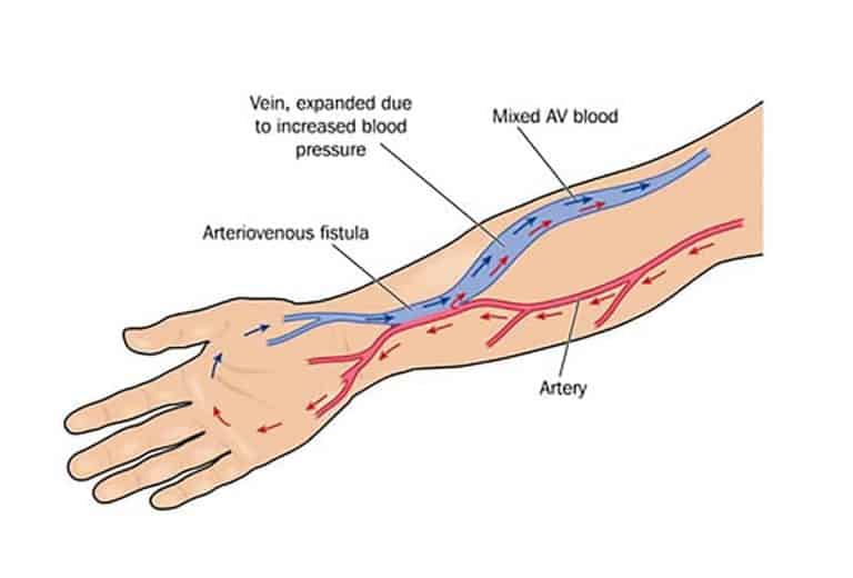 Fístula Arteriovenosa para Hemodiálise: Saiba mais sobre esse método de ...
