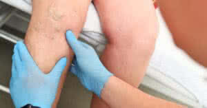 Imagem de um hlebologista examinando um paciente com varizes em sua perna. As varizes são veias dilatadas e tortuosas que podem causar desconforto e dor. Saiba mais sobre o que são varizes e como tratá-las no nosso post.
