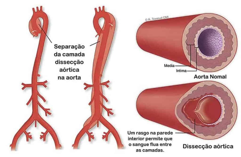 dissecção de aorta - Vaso sanguíneo
