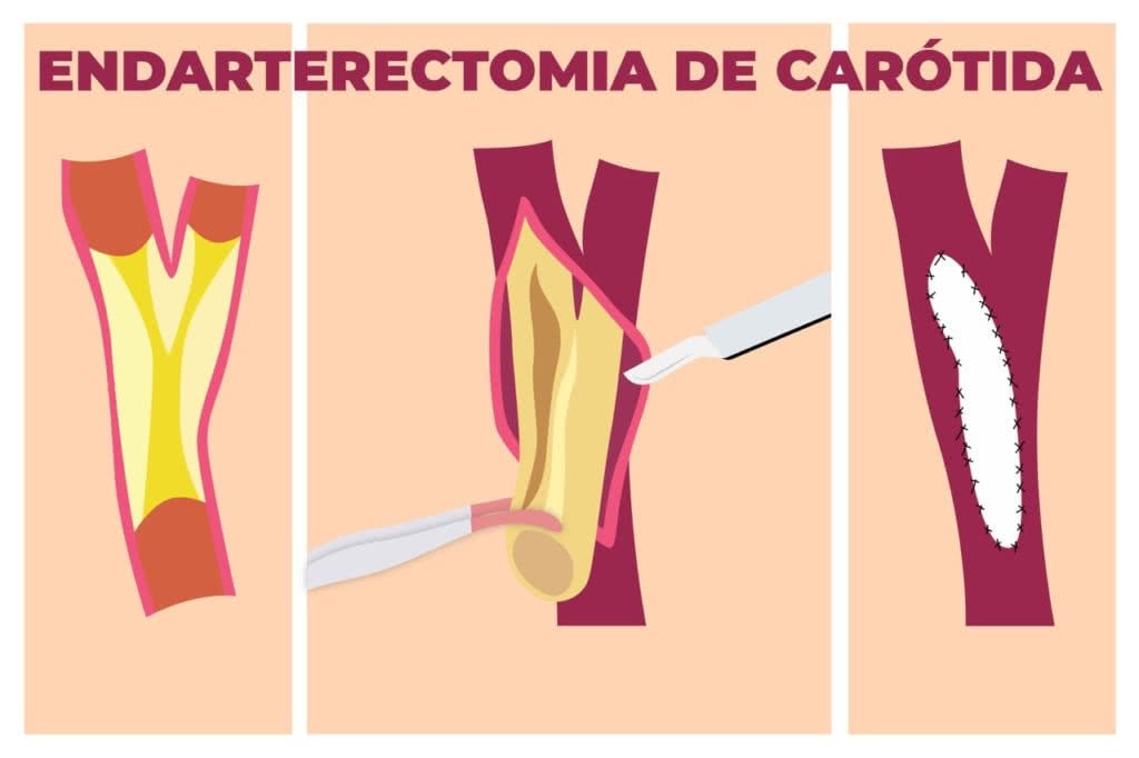 Endarterectomia de Carótida - Perna