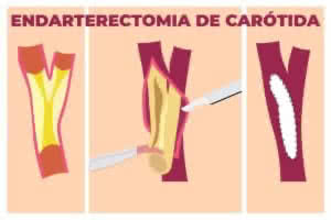 Endarterectomia de Carótida - Perna