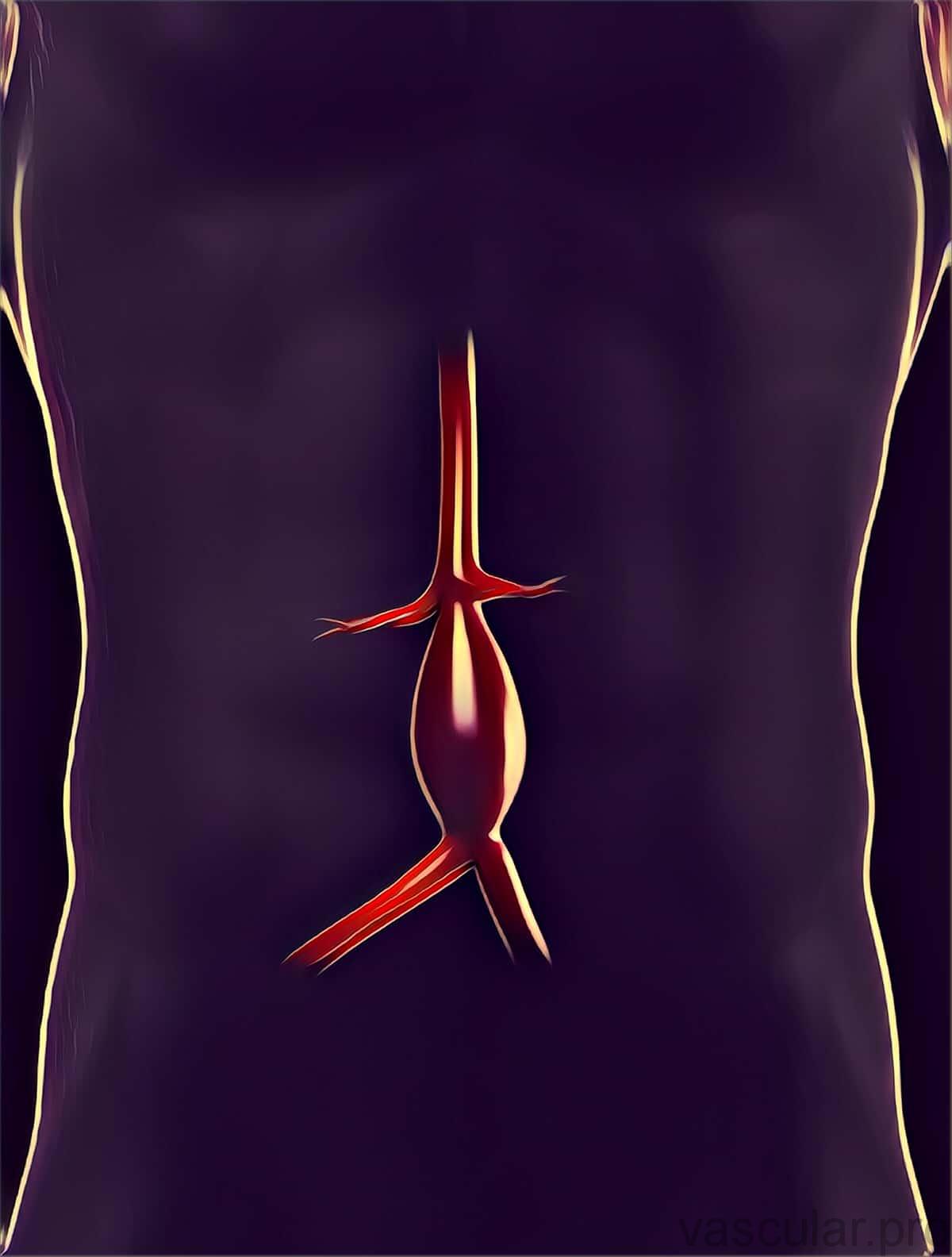 Aneurisma da Aorta Abdominal (AAA) - Vascular.pro