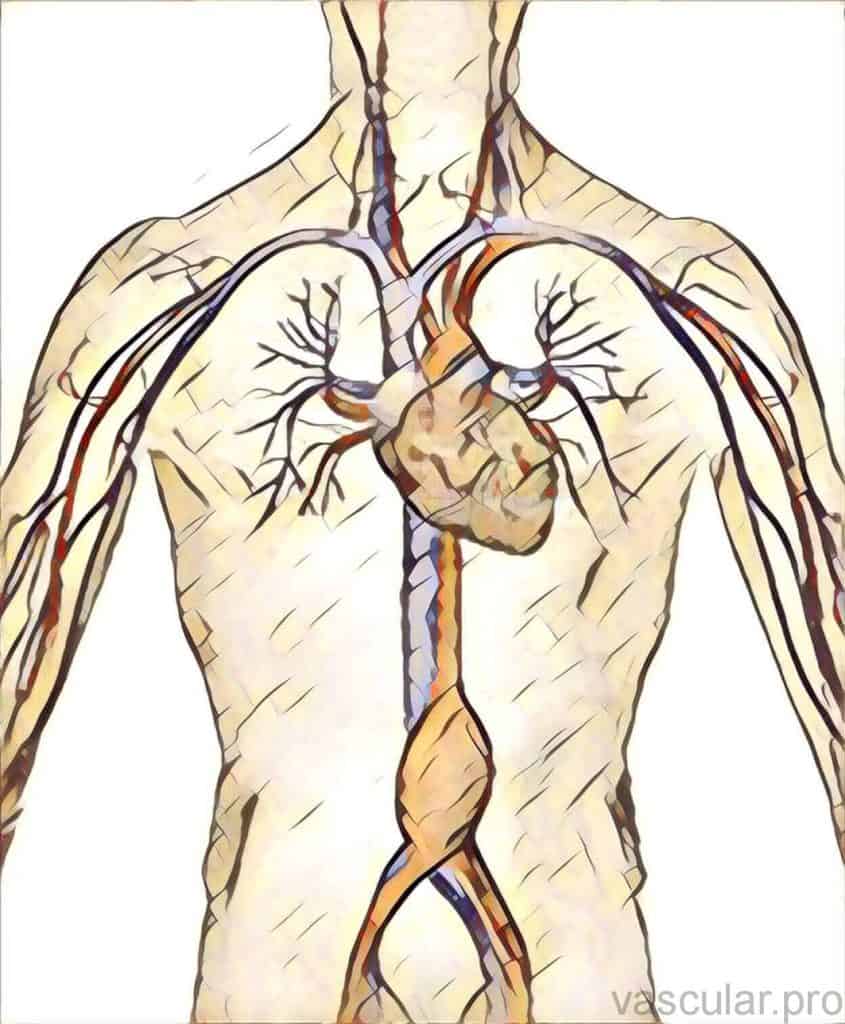 Aneurisma da aorta