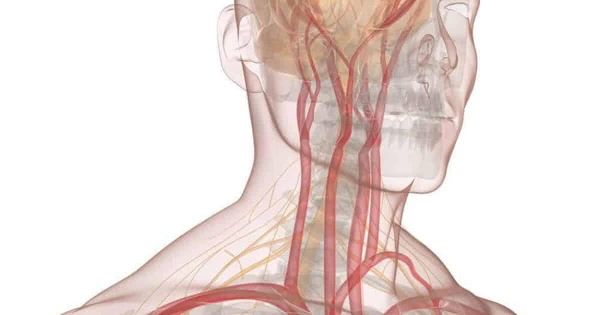 Doença Das Artérias Carótidas é Causa De Derrame Vascularpro 8676