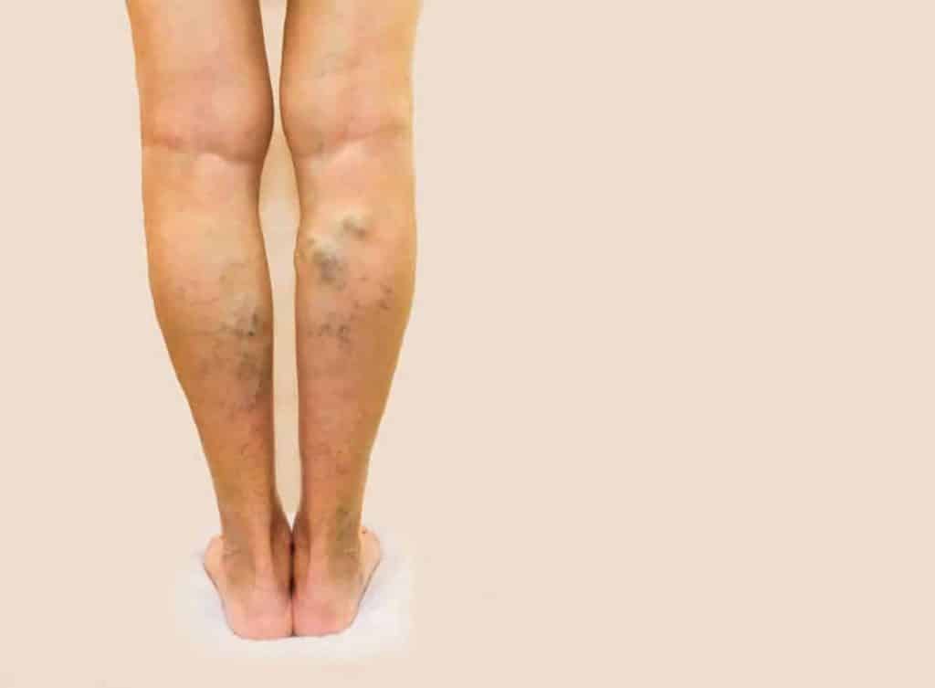 Homeopatia varicose vene. Picioare curate crema varicose pret ukraina