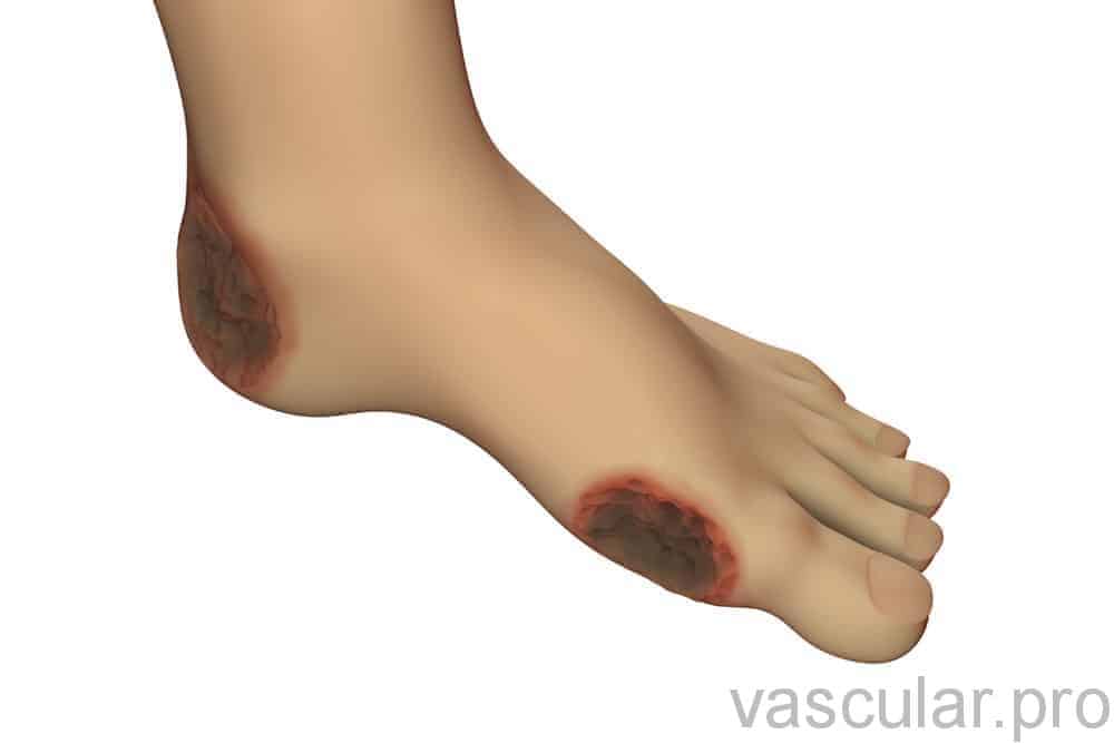 úlcera venosa - Úlcera de pé diabético