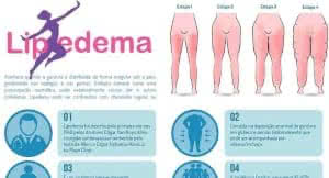 infográfico lipedema - Lipedema