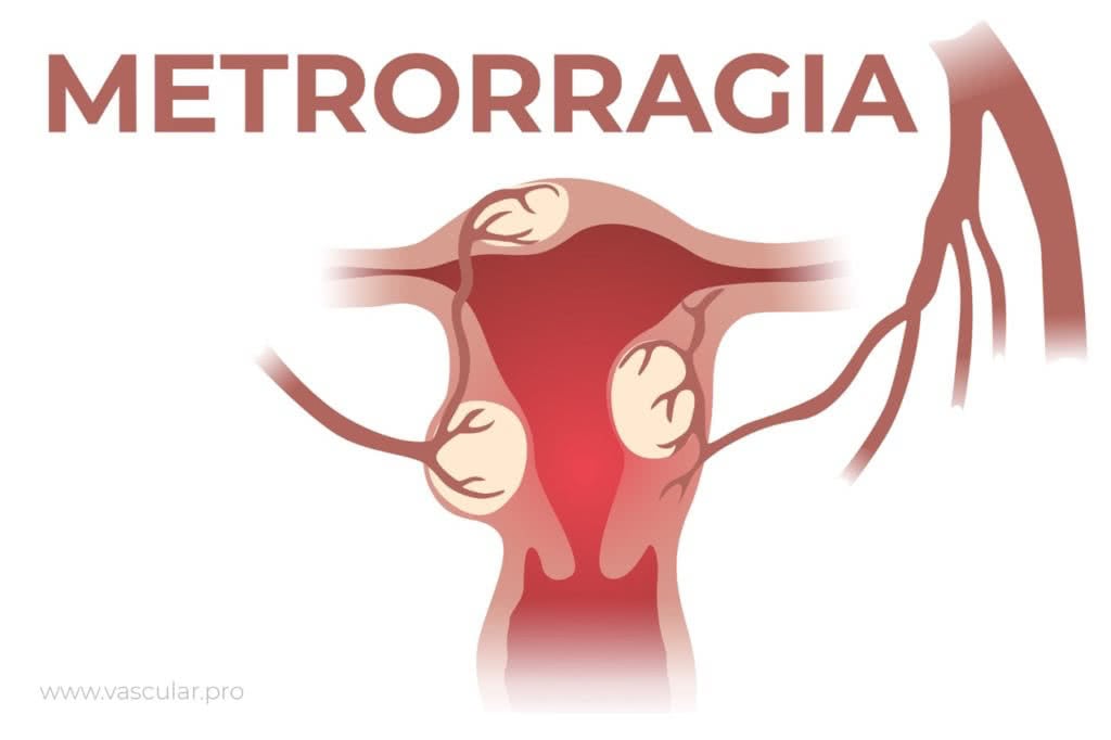 metrorragia - Fibroma uterino