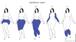 Lipedema