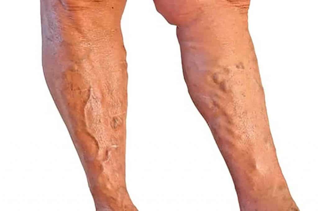 Unguent pentru venele varicoase sub genunchi - Venele mărite la picioare
