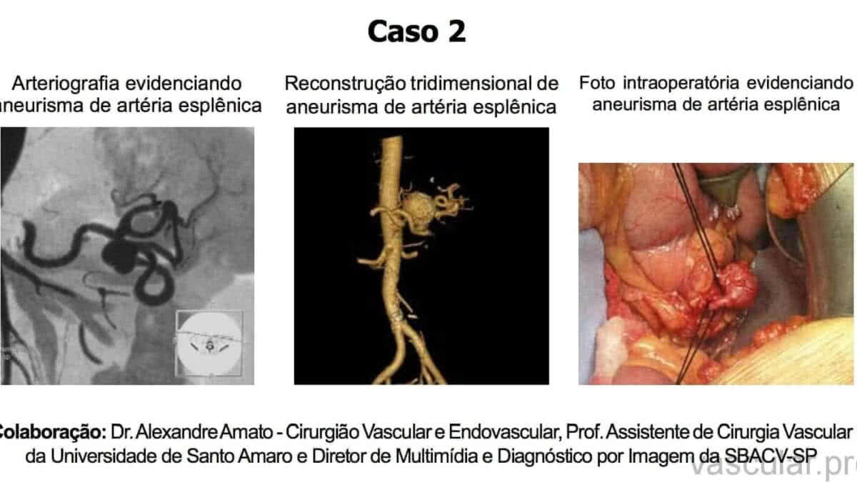 Lipedema – SBACVSP