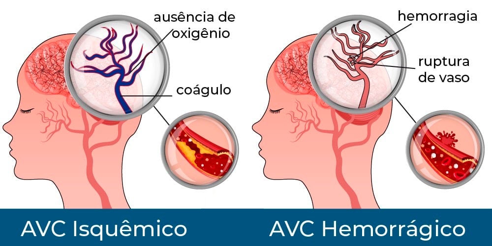 Diferenças entre o AVC isquemico e o AVC hemorrágico