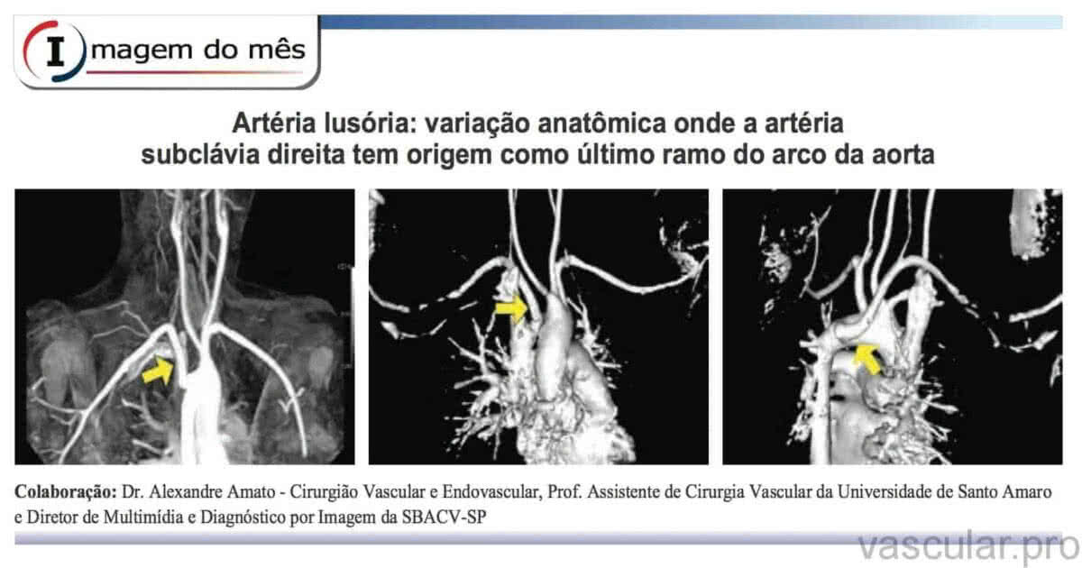 Artéria Lusória Variação Anatômica Da Artéria Subclávia Direita Caso