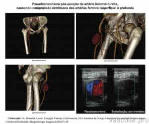 Artéria femoral