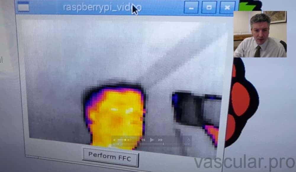 Imagem de termografia vascular capturada pela câmera termográfica - uma tecnologia que permite visualizar a temperatura da pele e dos vasos sanguíneos. Essa imagem pode ser útil para diagnósticos médicos e tratamentos de diversas condições de saúde.