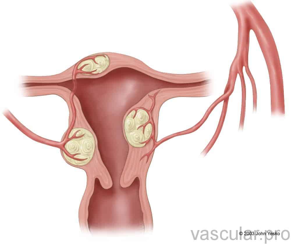 embolização de mioma - Fibroma uterino