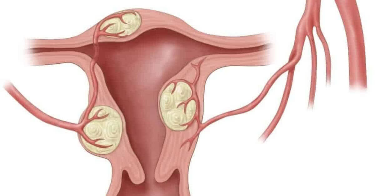 Causas de metrorragia. Sangramento do útero. Vascular.pro