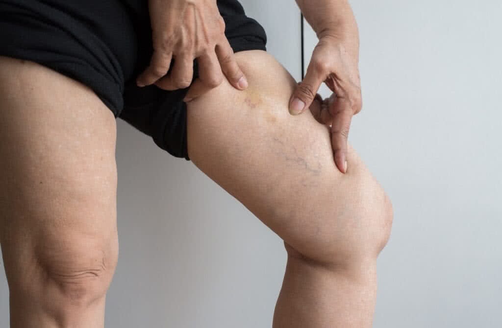 Imagem de close-up de pernas de um homem com varizes - Vasinhos também podem ocorrer em homens?