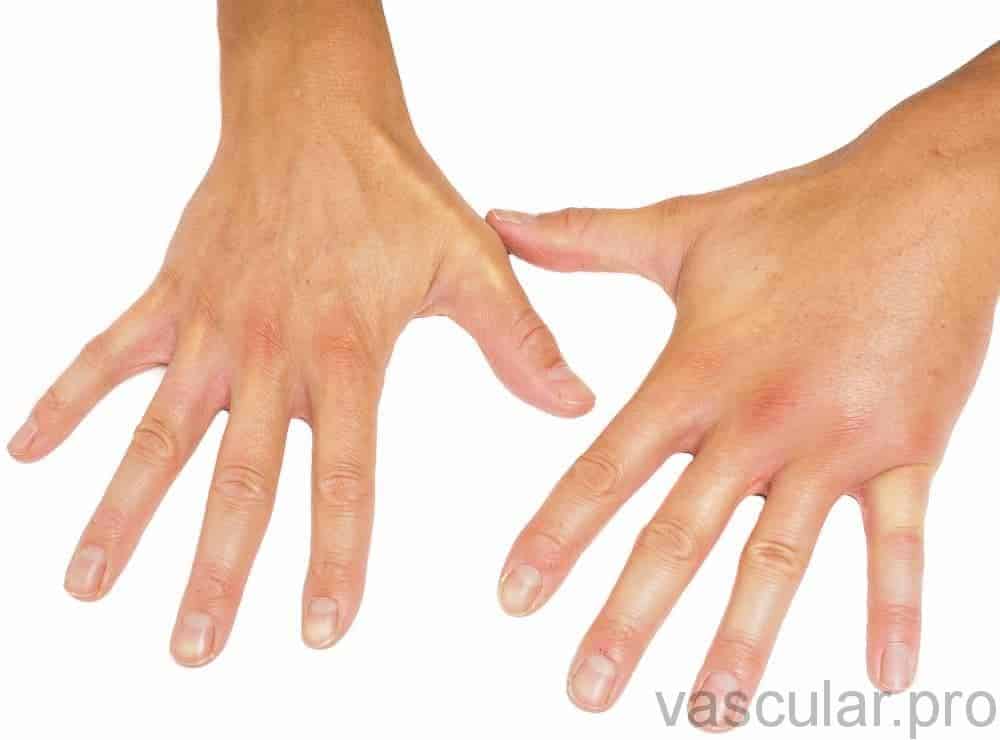 Síndrome das mãos inchadas<span class=