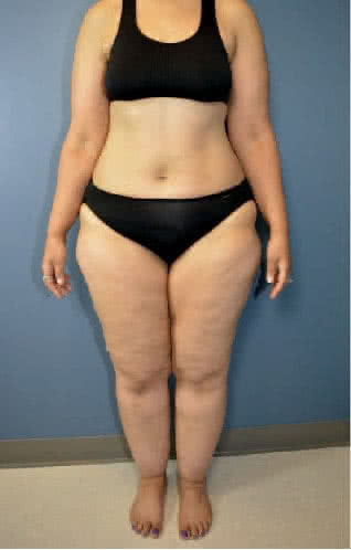 Lipedema grave: ela tirou 30 kg de gordura e pele