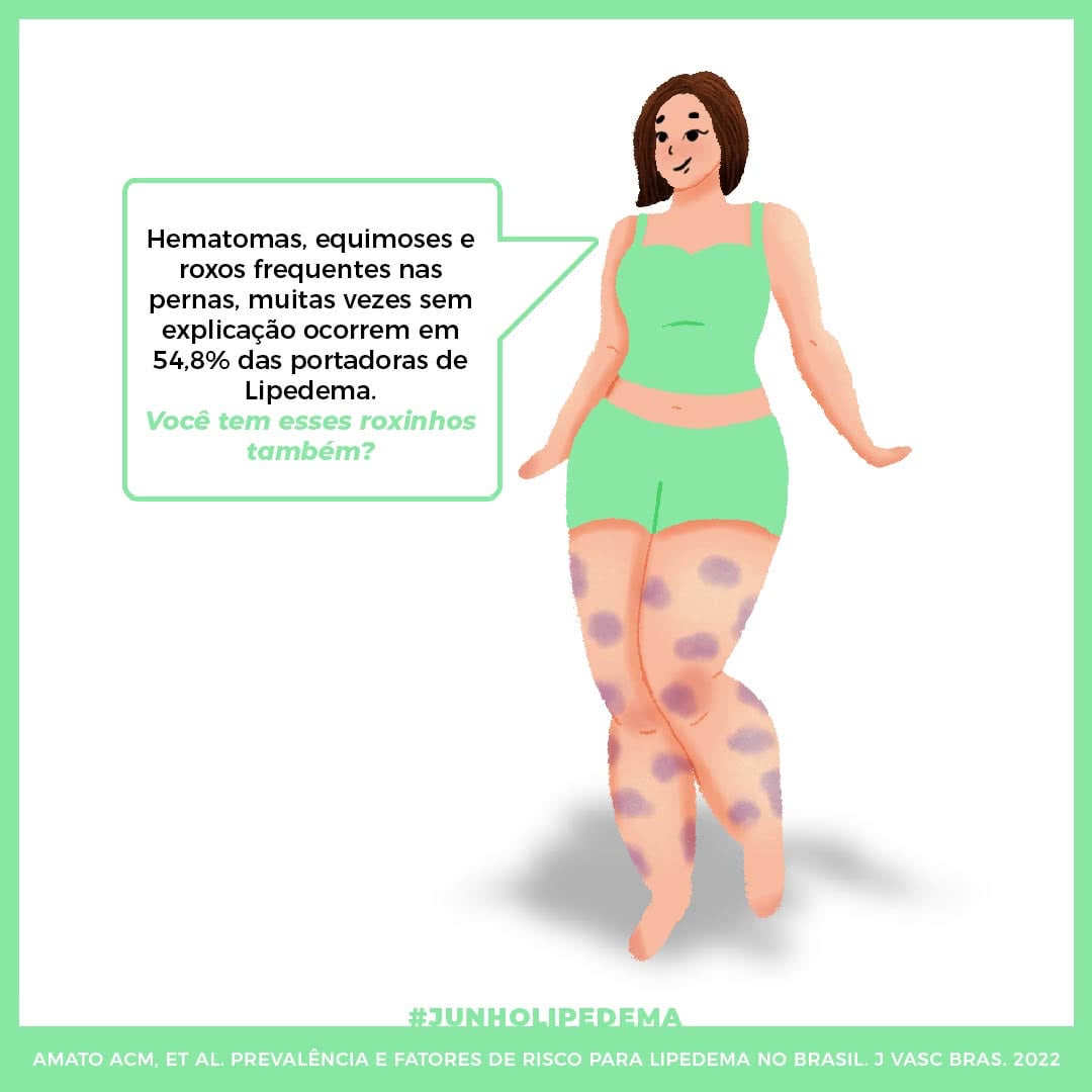Lipedema: o que é e como tratar o acúmulo de gordura nas pernas