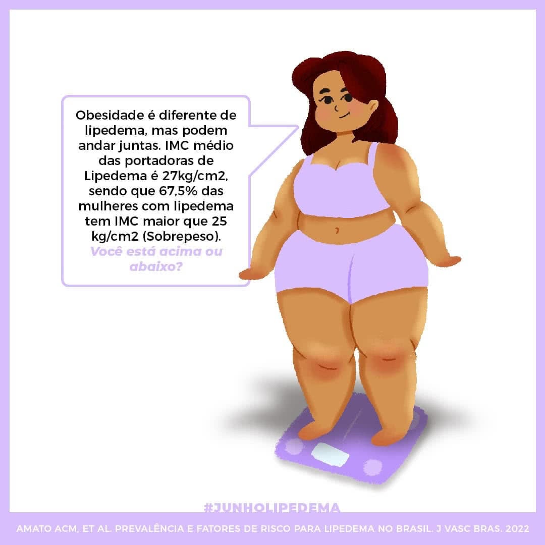 Lipedema: Entenda a diferença entre tumor de gordura e deposição anormal de  gordura nas pernas e glúteos.
