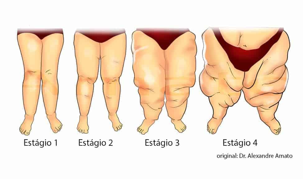 3 problemas frequentemente confundidos com lipedema e como diferenciá-los