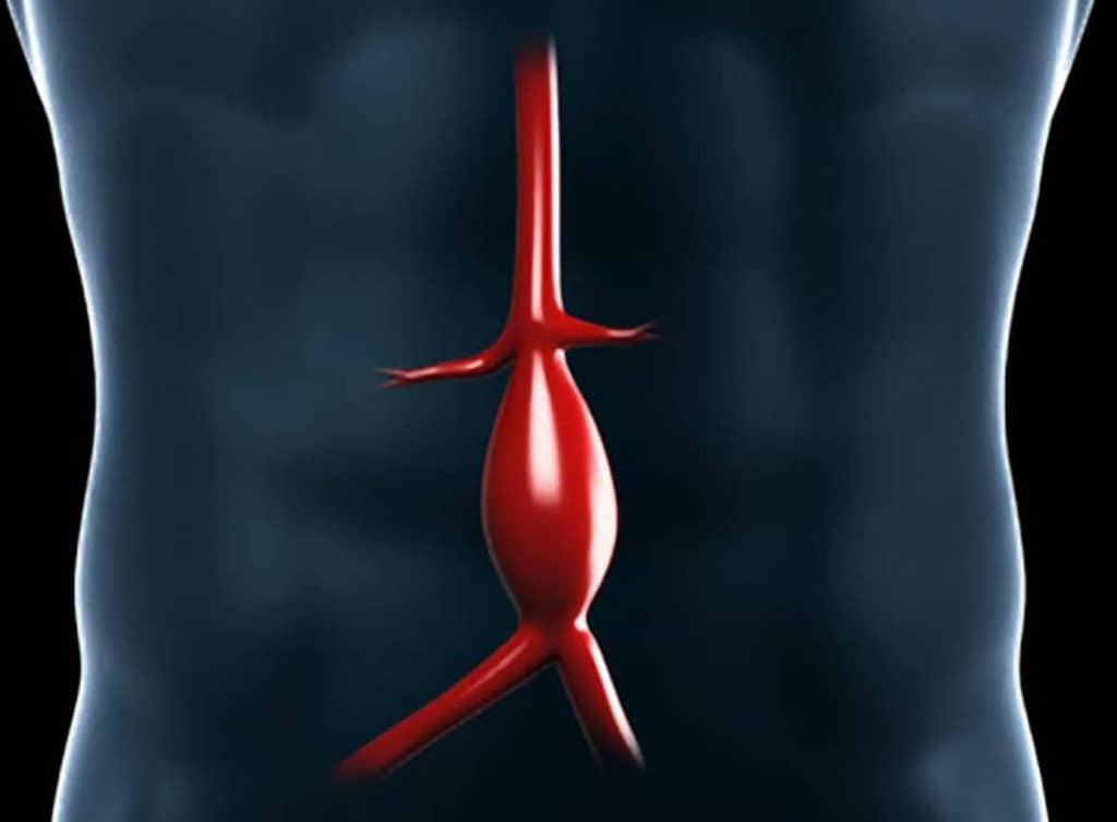 Como Saber Se A Arteria Esta Entupida Vascular Pro Como Saber Se A Arteria Esta Entupida Vascular Pro