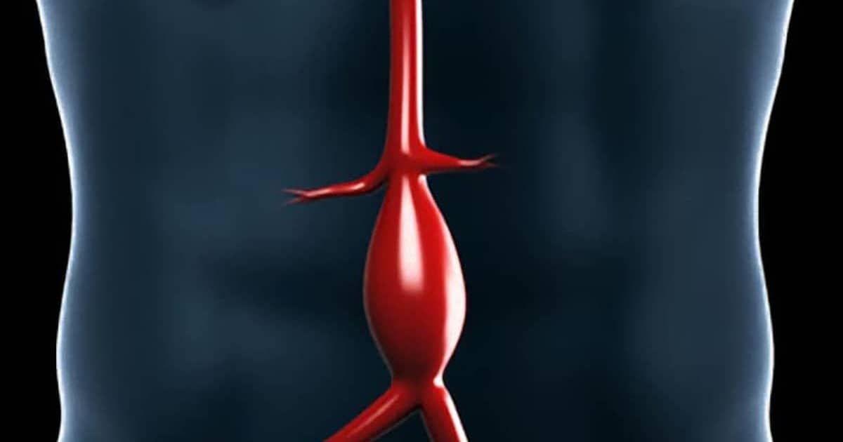 Aneurisma da Aorta Abdominal - Vascular.pro