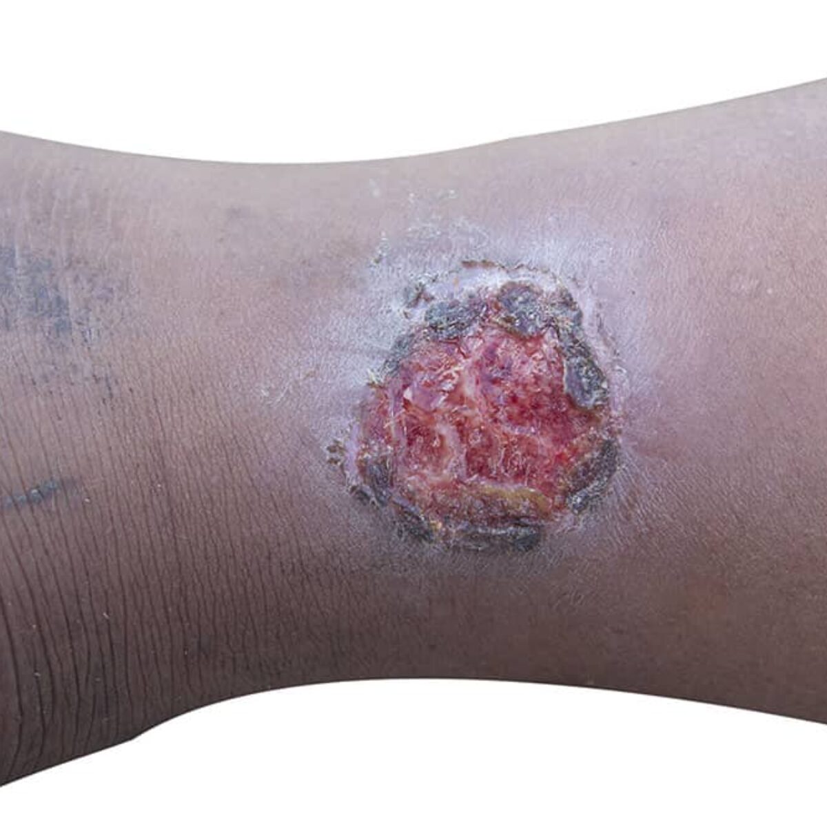 Ulcera Venosa Formación De Cirujanos: Impulso Vital Para La Salud En