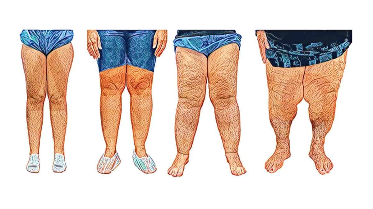 Fotos de Lipedema: Veja Desenhos Baseados em Fotos e Antes e