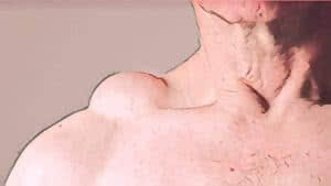 tumor gordura - lipoma