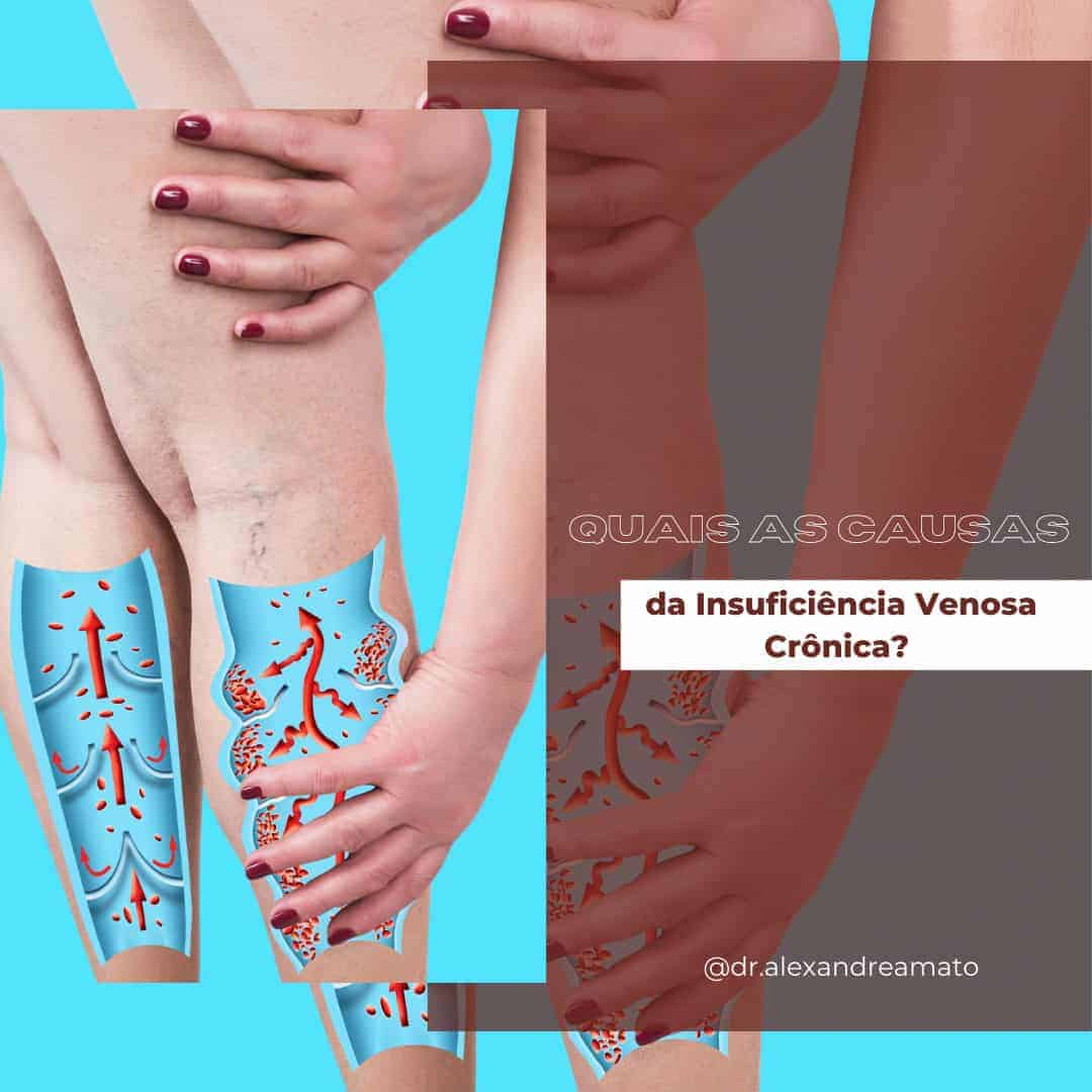 A insuficiência venosa crônica é uma