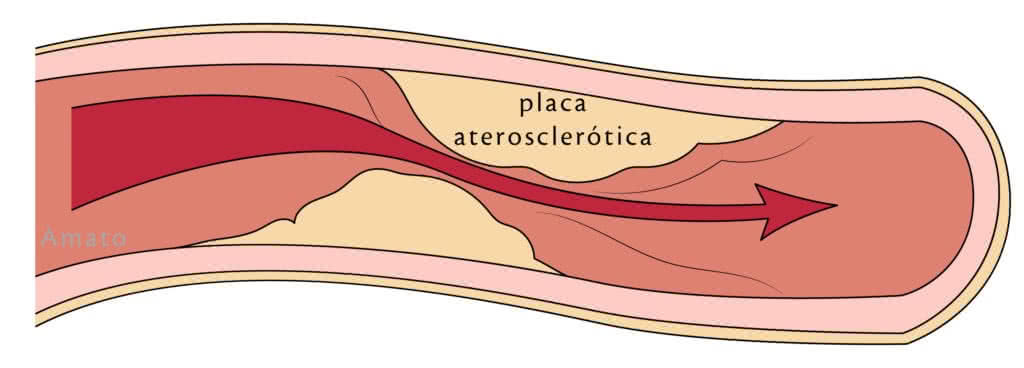 Placa aterosclerótica