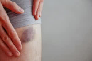 Imagem ilustrativa de um hematoma na perna, causado por injeção, ferimento ou contusão. Este é um exemplo comum de lesão que pode ocorrer em várias partes do corpo, como braços, pernas, joelhos, pulsos e cotovelos. Em nosso artigo, você encontrará informações sobre como prevenir e tratar hematomas em diferentes áreas do corpo.