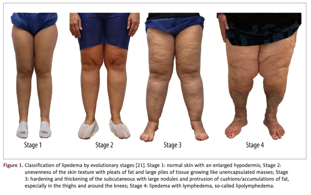 Lipedema fotos comparativas dos graus 1, 2, 3 e 4