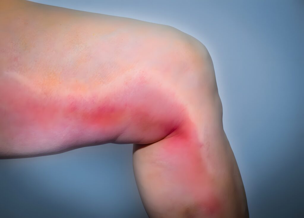 Flebite fotos — cordão venoso palpável e vermelhidão em membro inferior, caso 2