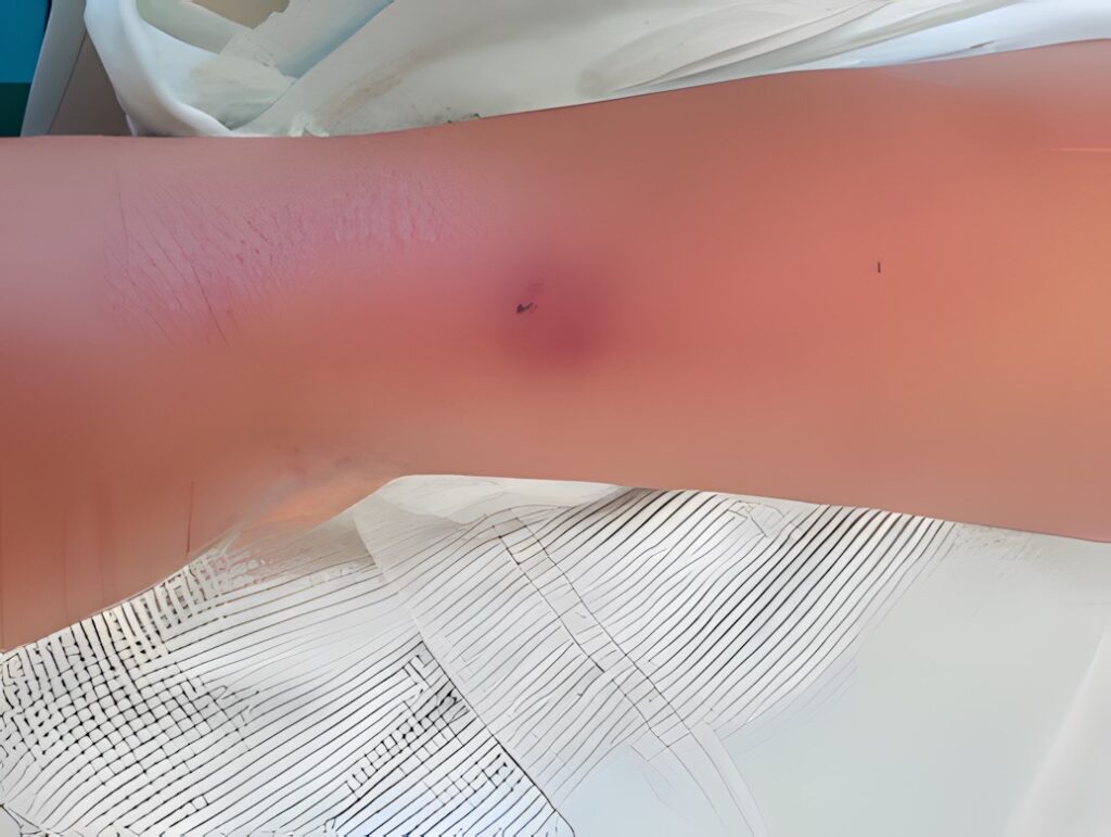 Flebite fotos — aspecto clínico da inflamação venosa superficial, caso 4
