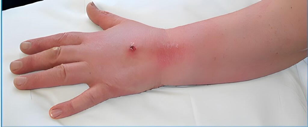 Flebite fotos — hiperpigmentação residual após tromboflebite superficial, caso 5