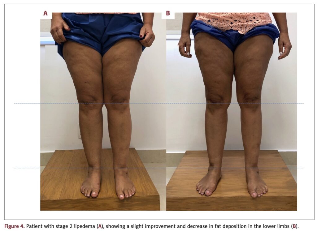 Lipedema fotos antes e depois — caso 2, tratamento não-cirúrgico