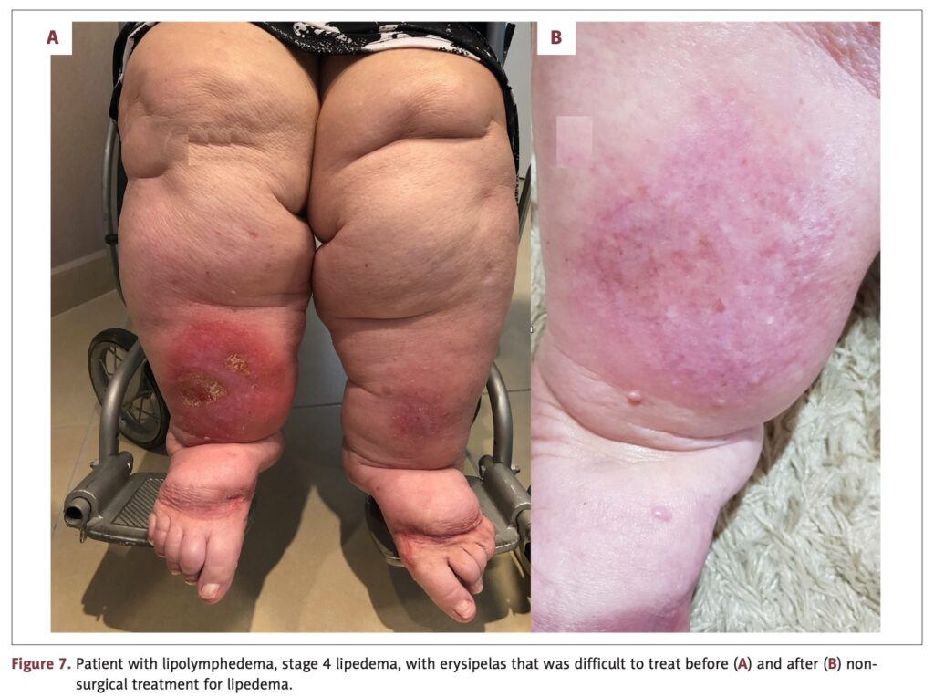 Lipedema antes e depois — caso 4, redução do contorno sem lipoaspiração