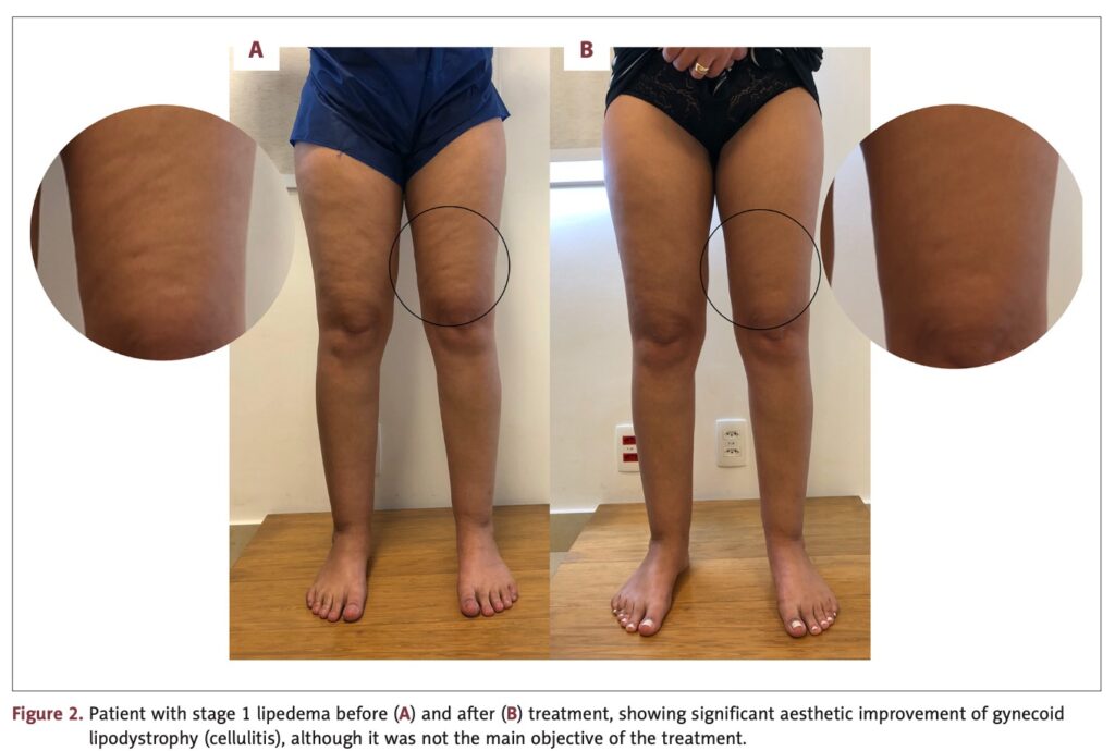 Lipedema fotos antes e depois — caso 5, recuperação do corte no tornozelo